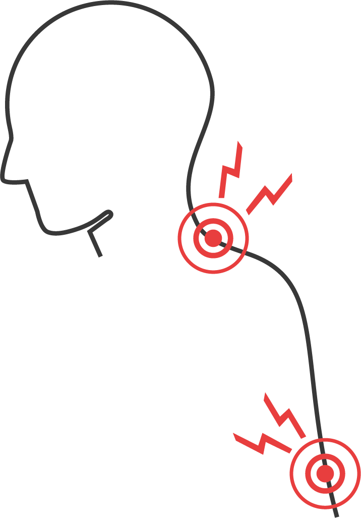 Grafik eines Kopfes mit zwei markierten Schmerzpunkten am Nacken, dargestellt durch rote Symbole und Wellenlinien.